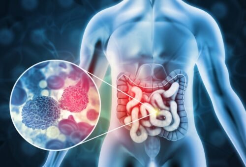 Colon cancer illustration