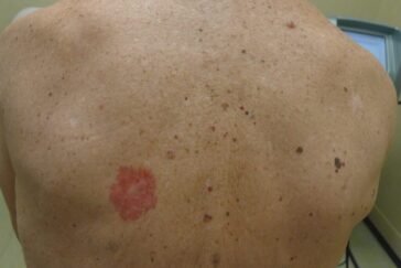 skin-cancer-on-back-