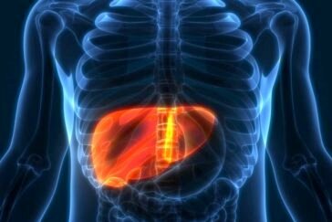 NAFLD