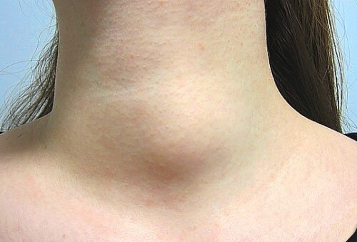 thyroid-lump-nodule-in-front-of-the-neck